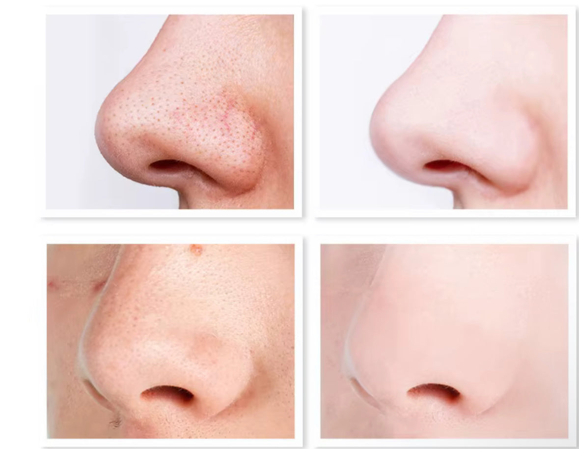 Bande de Nettoyage du Nez à la Vitamine C – Dr Rashel
